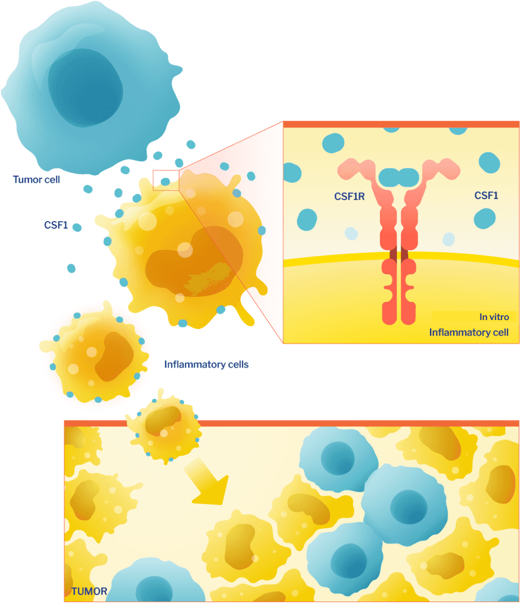 A tumor cell, CSF1, and inflammatory cells with CSF1R and CSF1 present